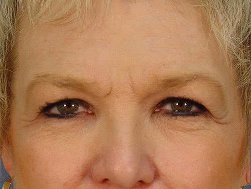 Case--9352 | Before Brow Lift 