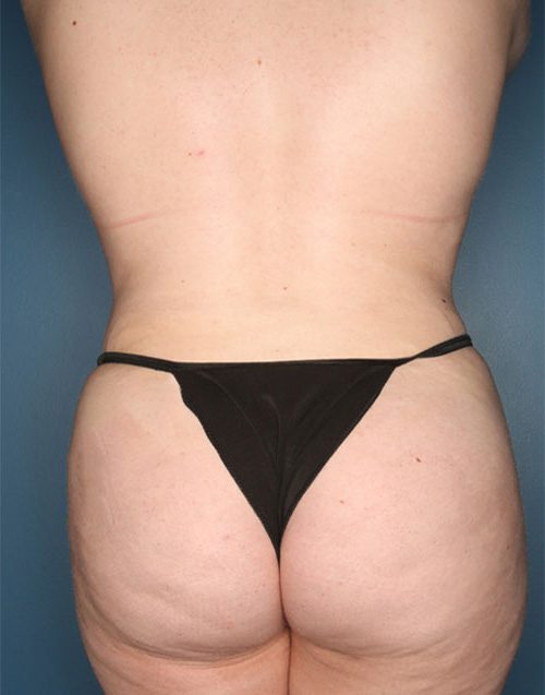Case--7203 | After Buttock Augmentation with Fat 