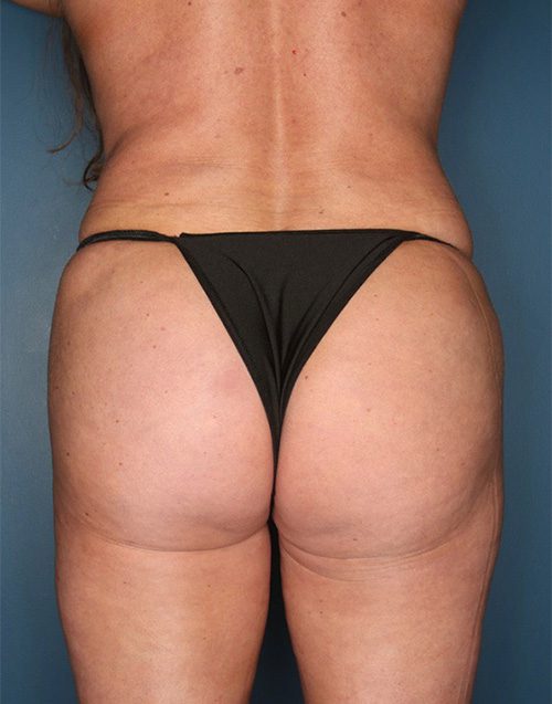 Case--867 | After Buttock Augmentation with Fat 