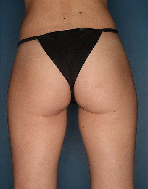 Brazilian Butt Lift (BBL) in Birmingham, AL Patient Before