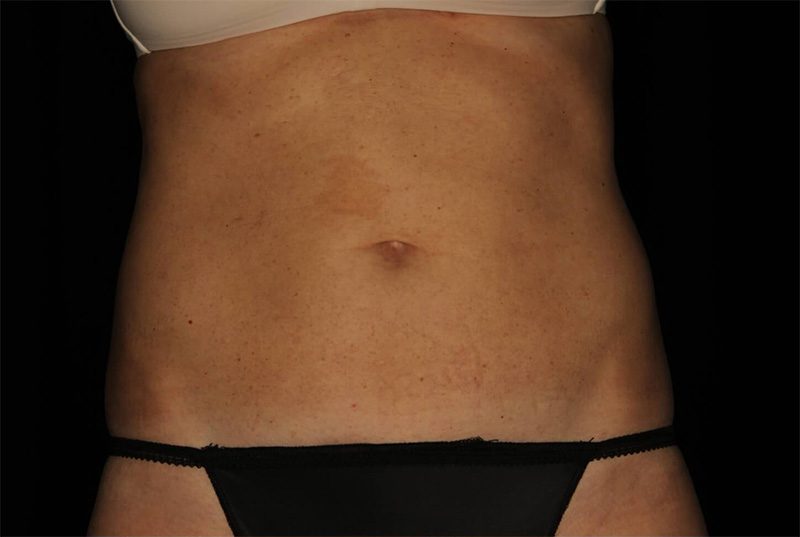 Case--5462 | After CoolSculpting® 