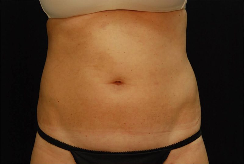 Case--5462 | Before CoolSculpting® 