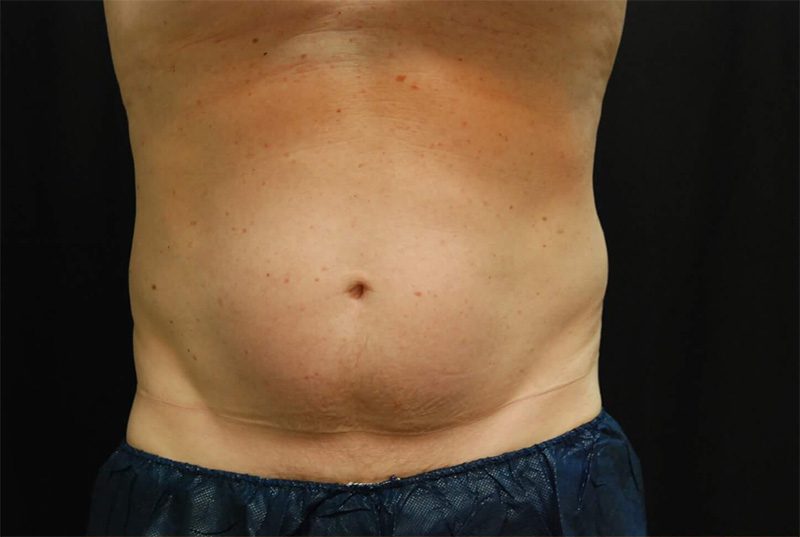 CoolSculpting® Patient Before