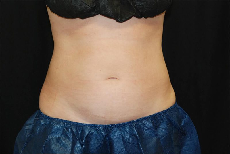 Case--8915 | After CoolSculpting® 