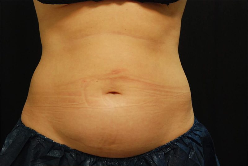 Case--8915 | Before CoolSculpting® 