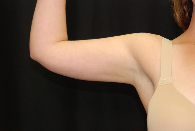 Case--790 | After CoolSculpting® 