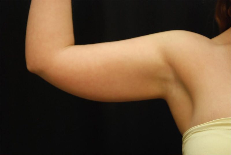 Case--790 | Before CoolSculpting® 