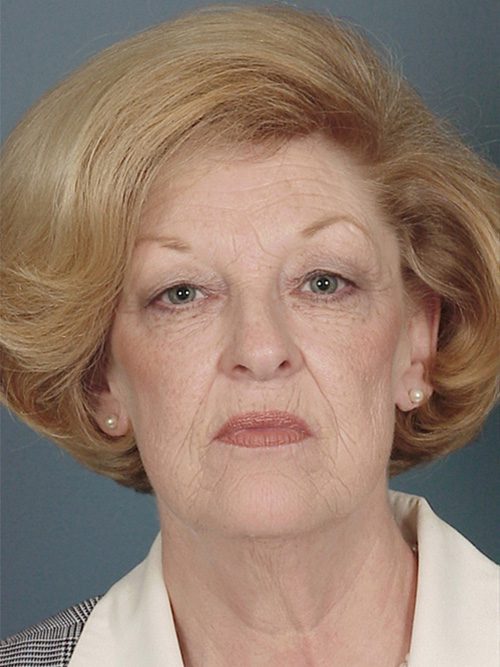 Case--446 | Before Facelift 