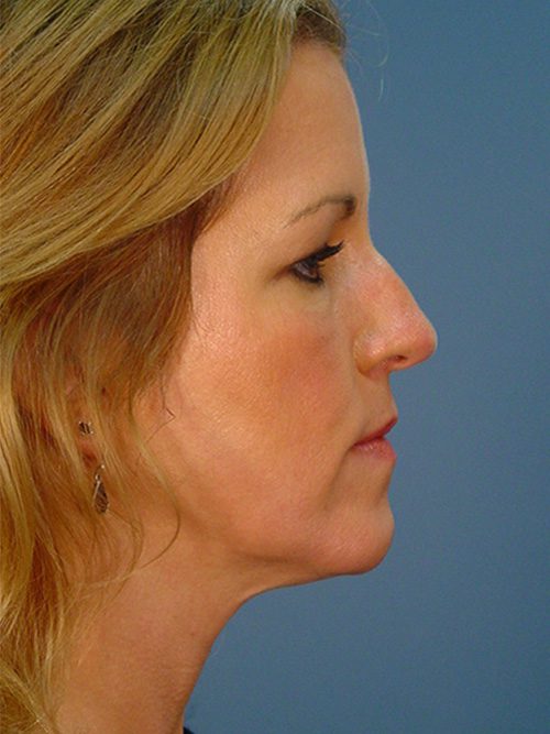 Neck Lift Surgery Patient Before