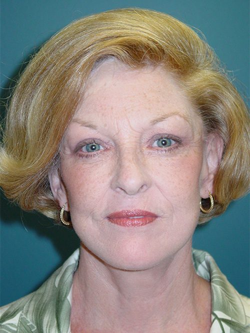 Case--446 | After Facelift 