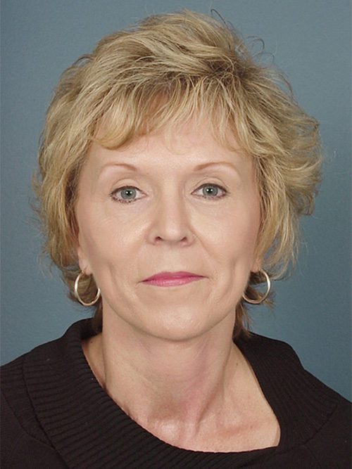 Case--8188 | After Facelift 