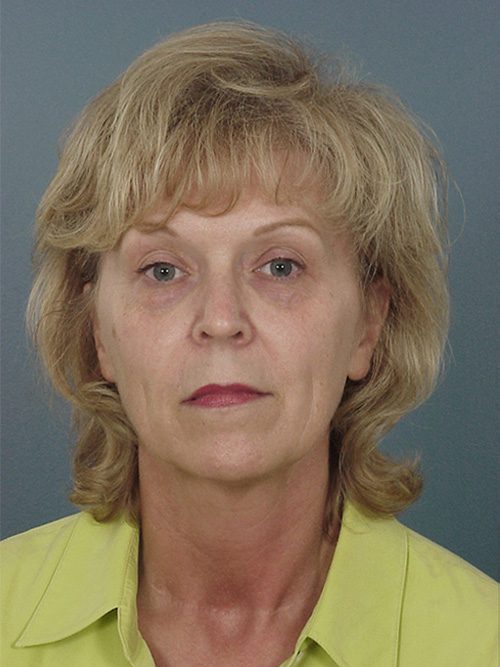 Case--8188 | Before Facelift 