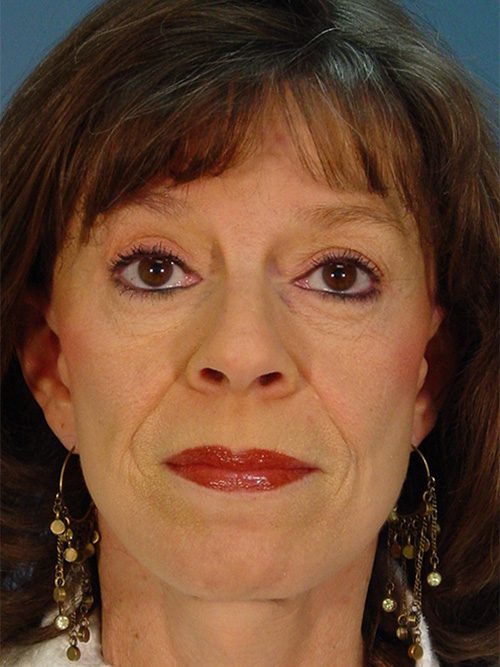 Case--4807 | After Facelift 