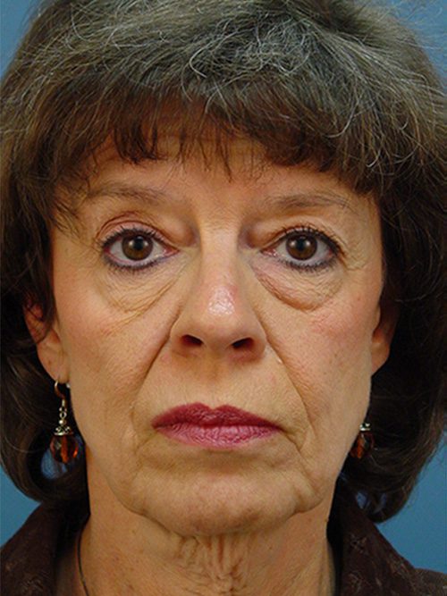 Case--4807 | Before Facelift 