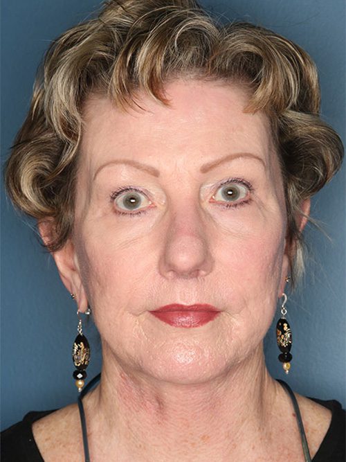 Case--669 | After Facelift 