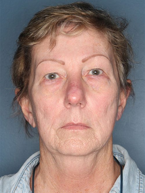 Case--669 | Before Facelift 