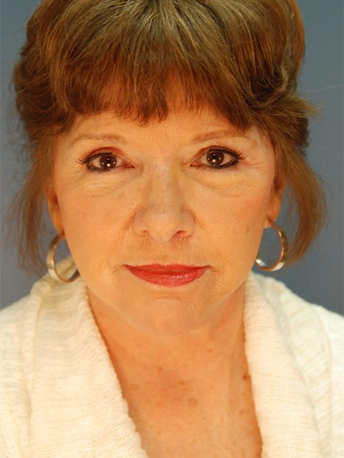 Case--6527 | After Facelift 