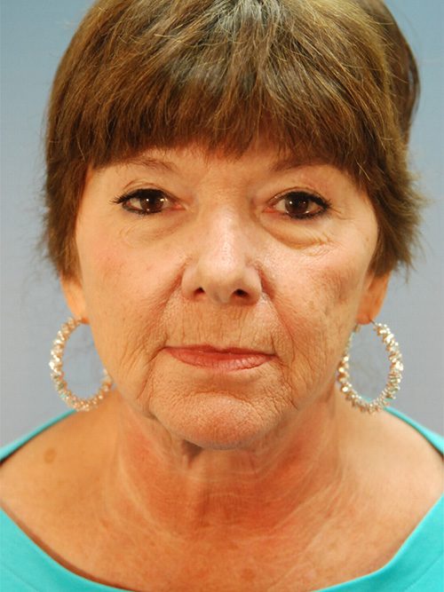 Case--6527 | Before Facelift 