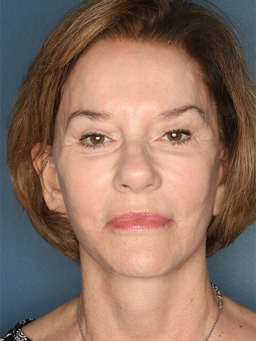 Case--7627 | After Facelift 