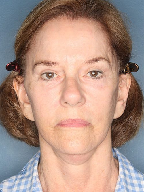 Case--7627 | Before Facelift 