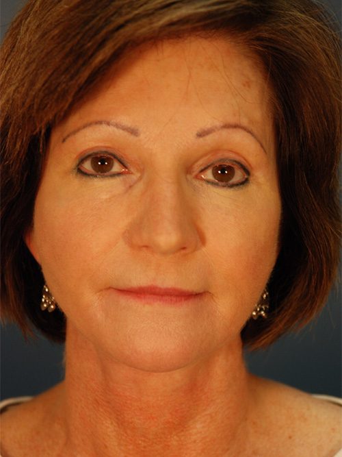 Case--5585 | After Facelift 