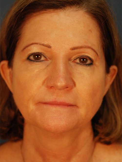 Case--5585 | Before Facelift 