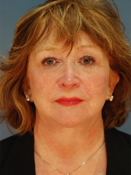 Case--4984 | After Facelift 