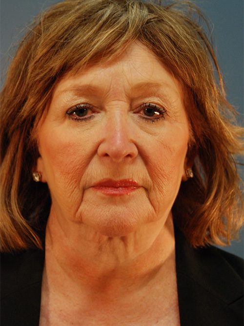 Case--4984 | Before Facelift 