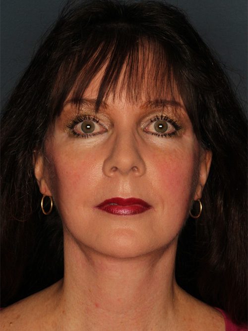 Case--3234 | After Chin Augmentation 