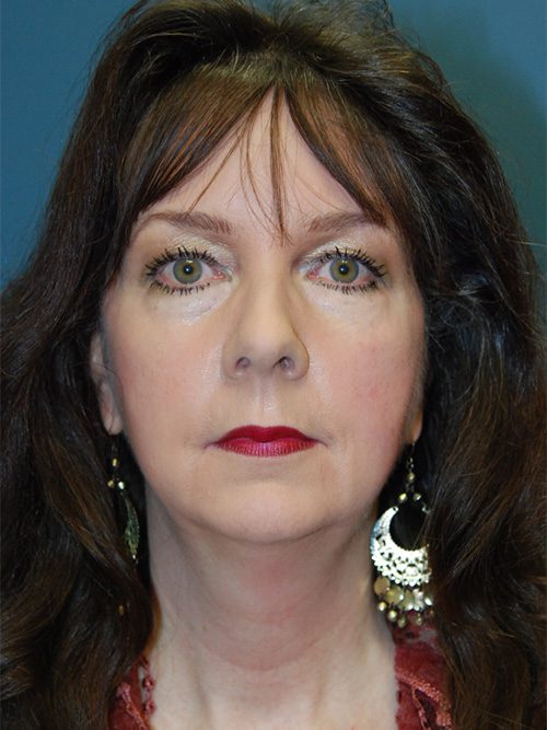 Case--3234 | Before Chin Augmentation 