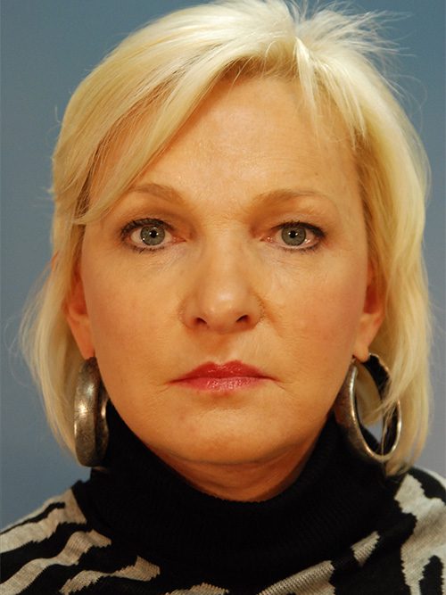 Case--1774 | After Facelift 