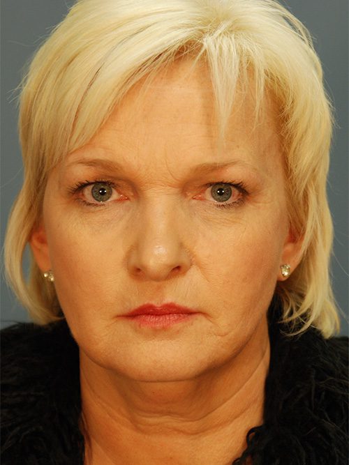 Case--1774 | Before Facelift 