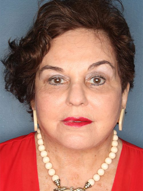 Case--6415 | After Facelift 