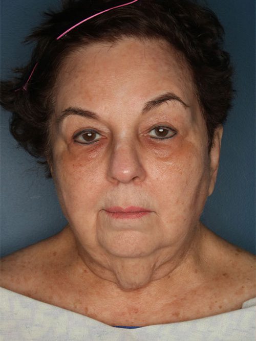 Case--6415 | Before Facelift 