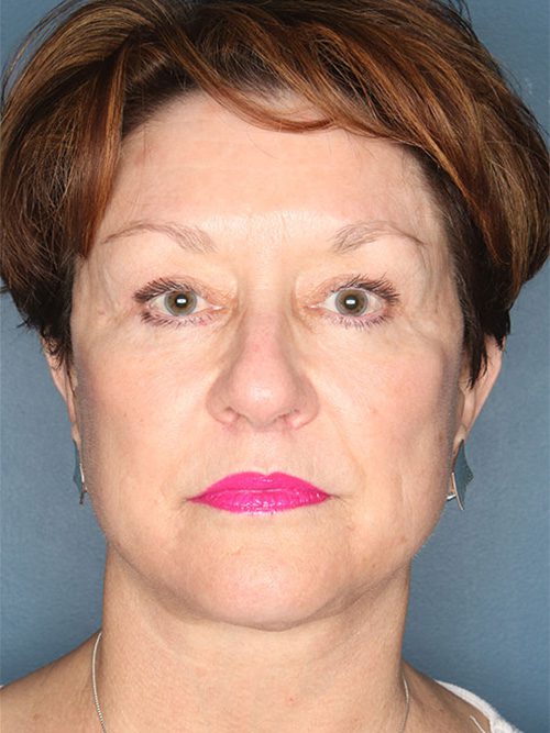 Case--2887 | After Facelift 