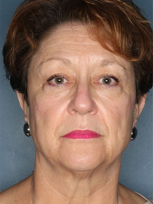 Case--2887 | Before Facelift 