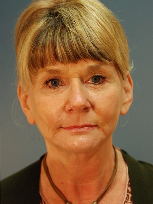 Case--6213 | After Facelift 