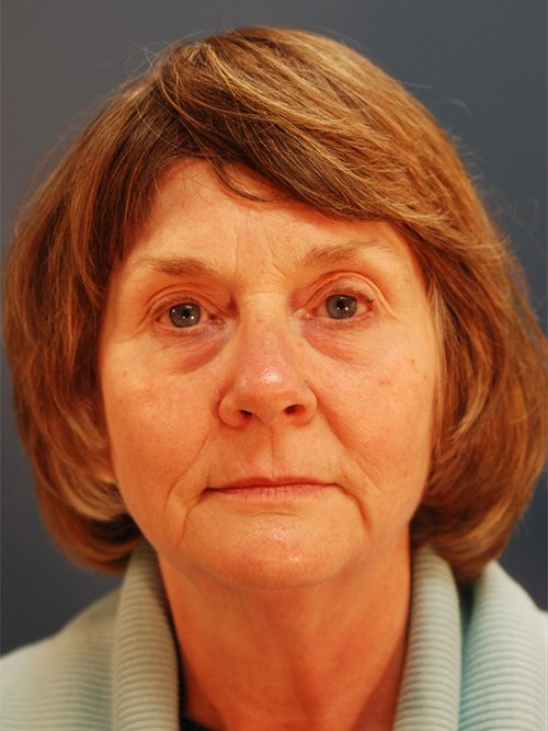 Case--6213 | Before Facelift 