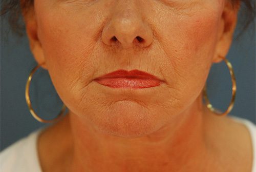 Case--2866 | After Lip Augmentation 