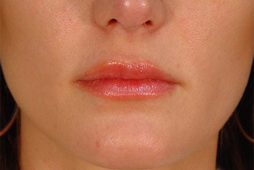 Case--1020 | After Lip Augmentation 