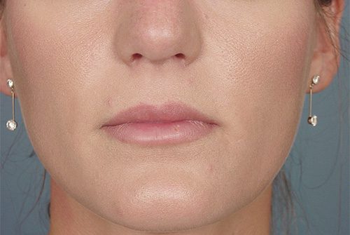 Case--1020 | Before Lip Augmentation 