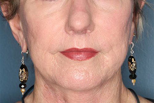 Case--5655 | After Lip Augmentation 