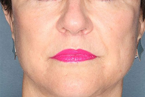 Case--8281 | After Lip Augmentation 