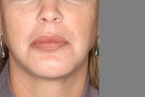 Case--7638 | After Lip Augmentation 