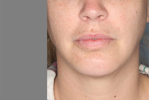 Case--7638 | Before Lip Augmentation 