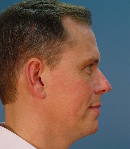 Before and After Case 6581 Photos Birmingham, AL Grotting Plastic