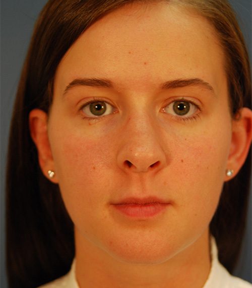 Case--2783 | Before Neck Contouring Using Liposuction 