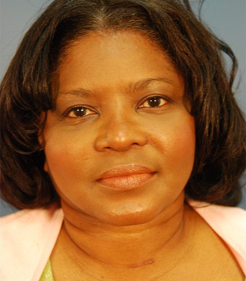 Case--5899 | After Neck Contouring Using Liposuction 