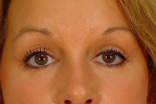 Case--1186 | After Lower Eyelid Surgery 