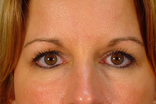 Case--1186 | Before Lower Eyelid Surgery 